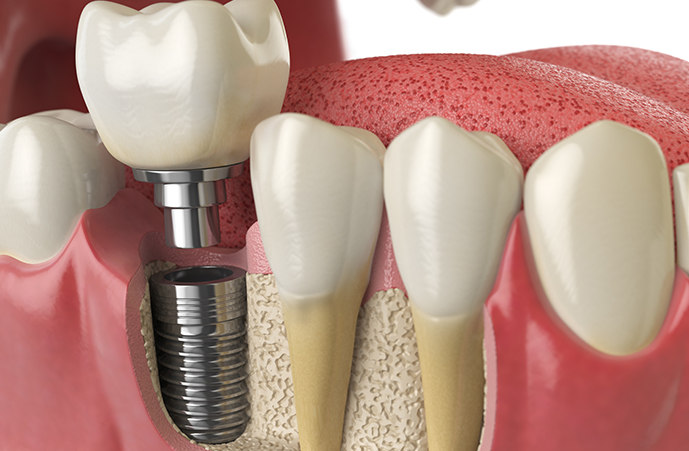 dental implants