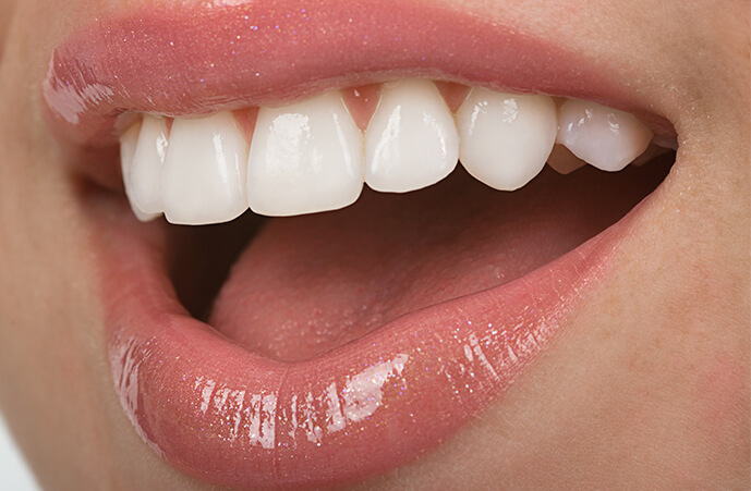 bonded composite veneers Dentist Epping Dentist