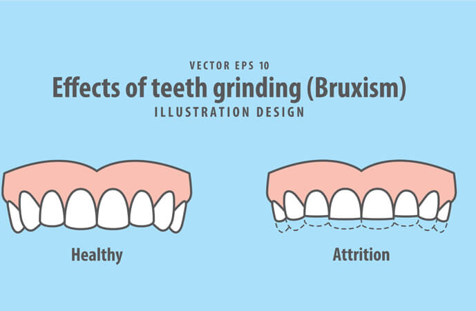 bruxism grinding Epping Dentist Epping