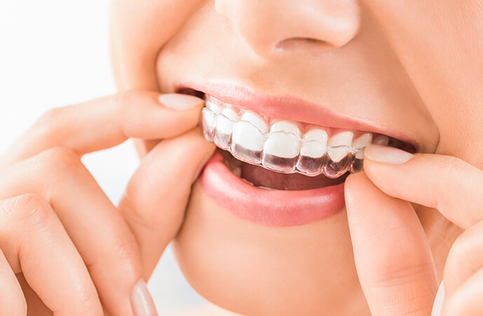 teeth invisalign Epping Dentist Epping