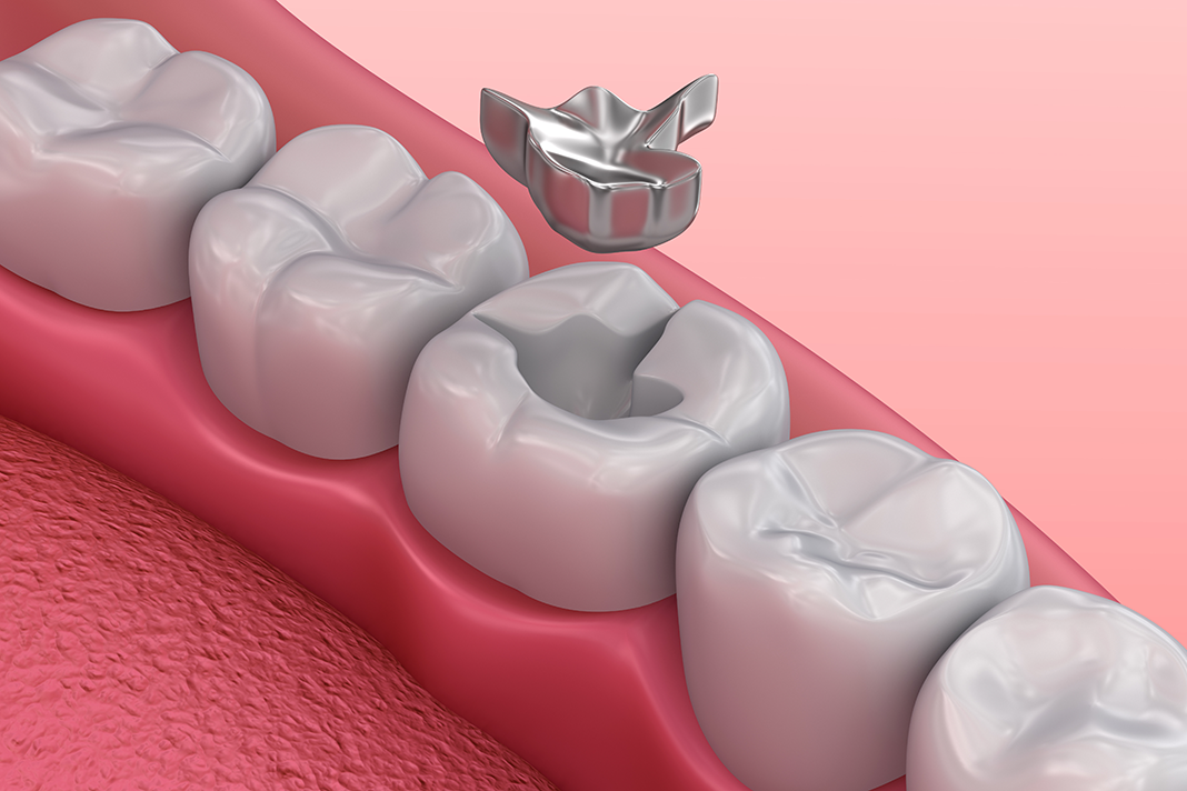 Which is better – composite or amalgam fillings?